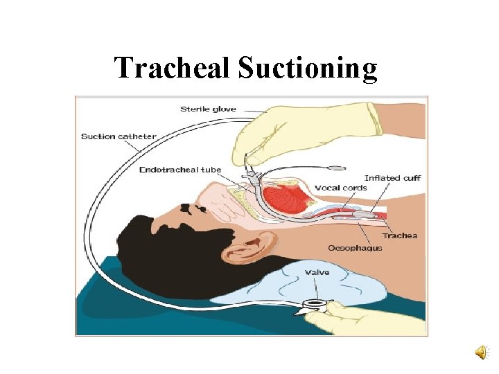 Tracheal Suctioning 