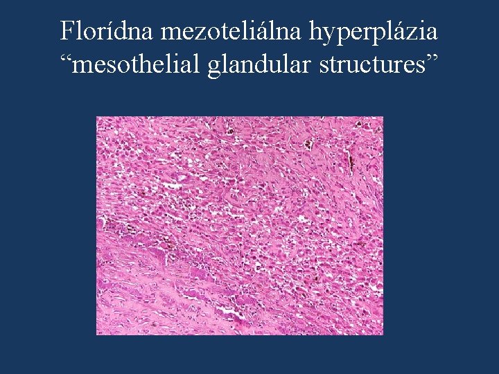 Florídna mezoteliálna hyperplázia “mesothelial glandular structures” 