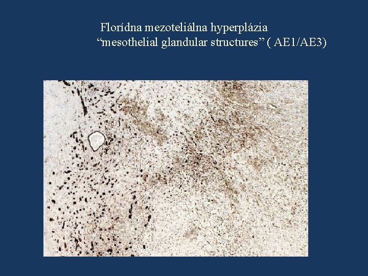 Florídna mezoteliálna hyperplázia “mesothelial glandular structures” ( AE 1/AE 3) 