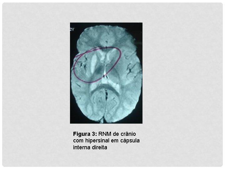 Figura 3: RNM de crânio com hipersinal em cápsula interna direita 