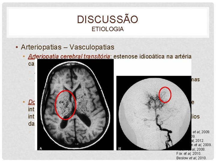 DISCUSSÃO ETIOLOGIA • Arteriopatias – Vasculopatias • Arteriopatia cerebral transitória: estenose idiopática na artéria
