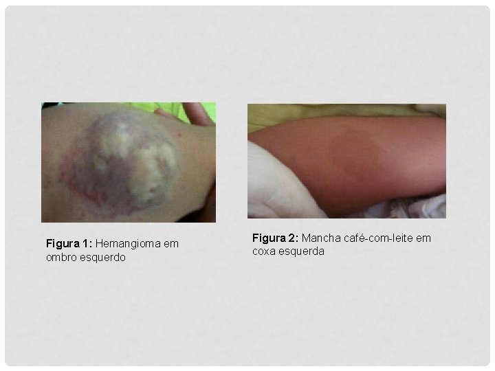 Figura 1: Hemangioma em ombro esquerdo Figura 2: Mancha café-com-leite em coxa esquerda 