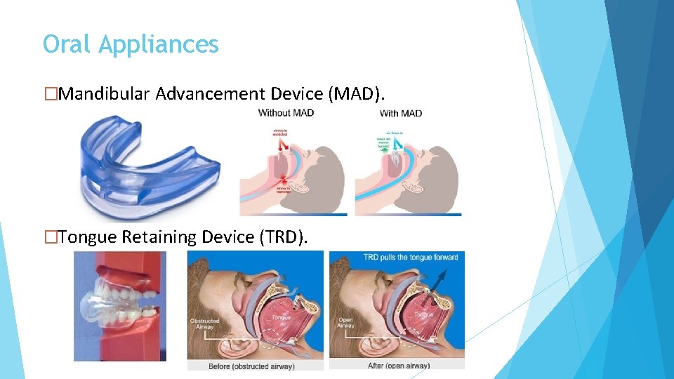 Oral Appliances �Mandibular Advancement Device (MAD). �Tongue Retaining Device (TRD). 