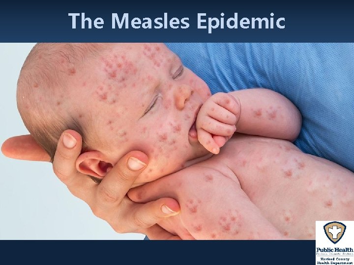 The Measles Epidemic 