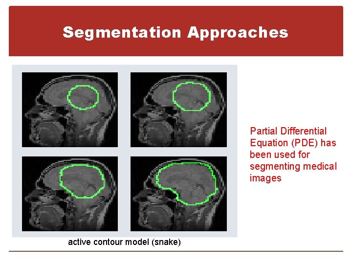 Segmentation Approaches Partial Differential Equation (PDE) has been used for segmenting medical images active