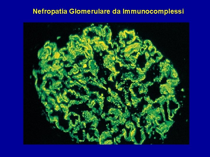 Nefropatia Glomerulare da Immunocomplessi 