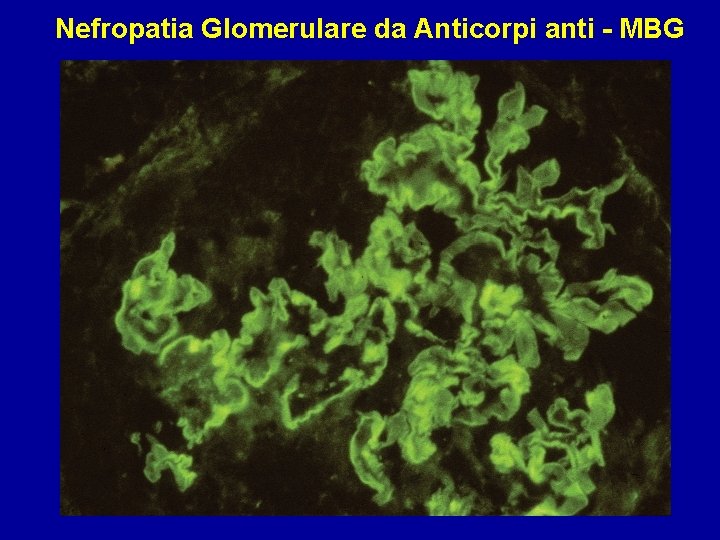 Nefropatia Glomerulare da Anticorpi anti - MBG 