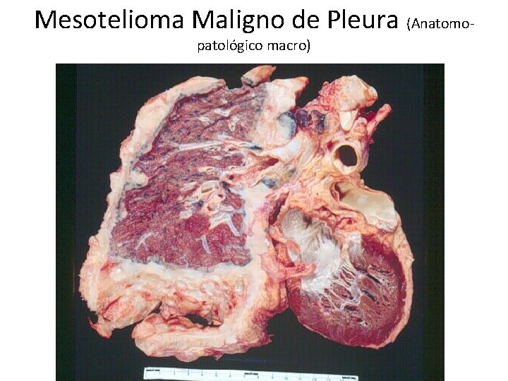 Mesotelioma Maligno de Pleura (Anatomopatológico macro) 