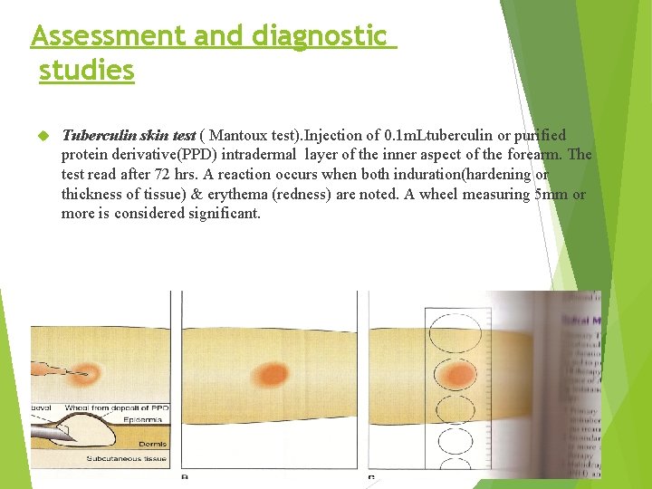 Assessment and diagnostic studies Tuberculin skin test ( Mantoux test). Injection of 0. 1