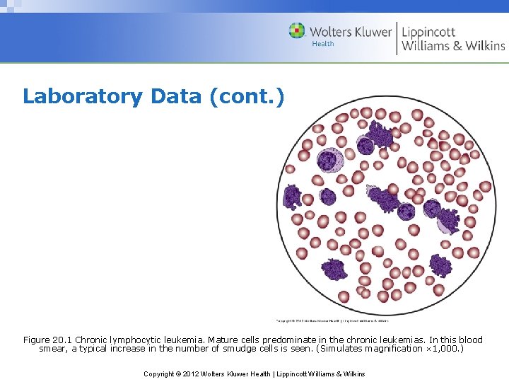 Laboratory Data (cont. ) Figure 20. 1 Chronic lymphocytic leukemia. Mature cells predominate in