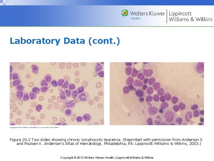 Laboratory Data (cont. ) Figure 20. 2 Two slides showing chronic lymphocytic leukemia. (Reprinted