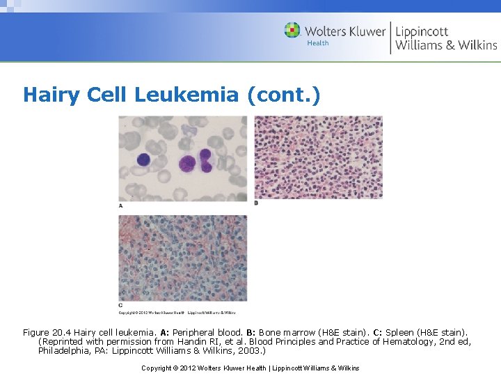 Hairy Cell Leukemia (cont. ) Figure 20. 4 Hairy cell leukemia. A: Peripheral blood.