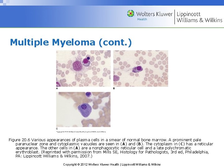 Multiple Myeloma (cont. ) Figure 20. 6 Various appearances of plasma cells in a