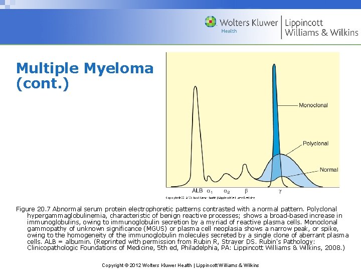 Multiple Myeloma (cont. ) Figure 20. 7 Abnormal serum protein electrophoretic patterns contrasted with