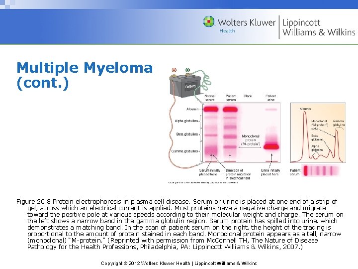 Multiple Myeloma (cont. ) Figure 20. 8 Protein electrophoresis in plasma cell disease. Serum