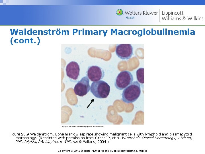 Waldenström Primary Macroglobulinemia (cont. ) Figure 20. 9 Waldenström. Bone marrow aspirate showing malignant