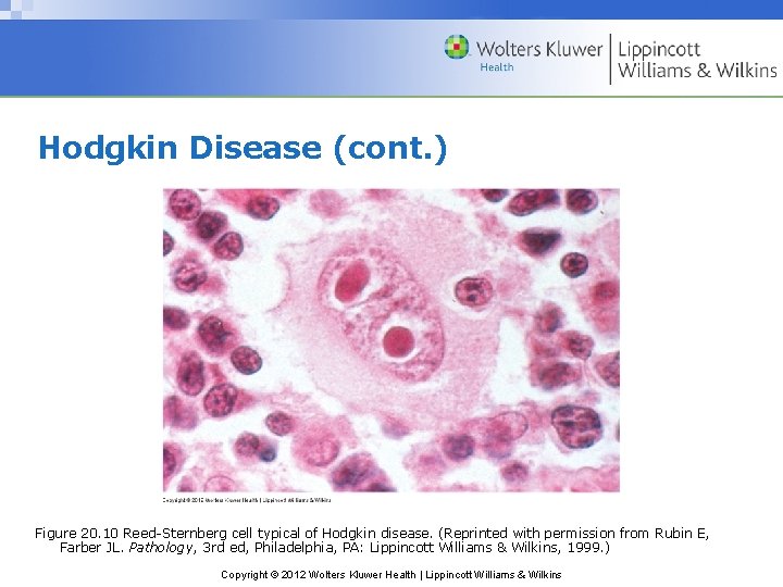 Hodgkin Disease (cont. ) Figure 20. 10 Reed-Sternberg cell typical of Hodgkin disease. (Reprinted