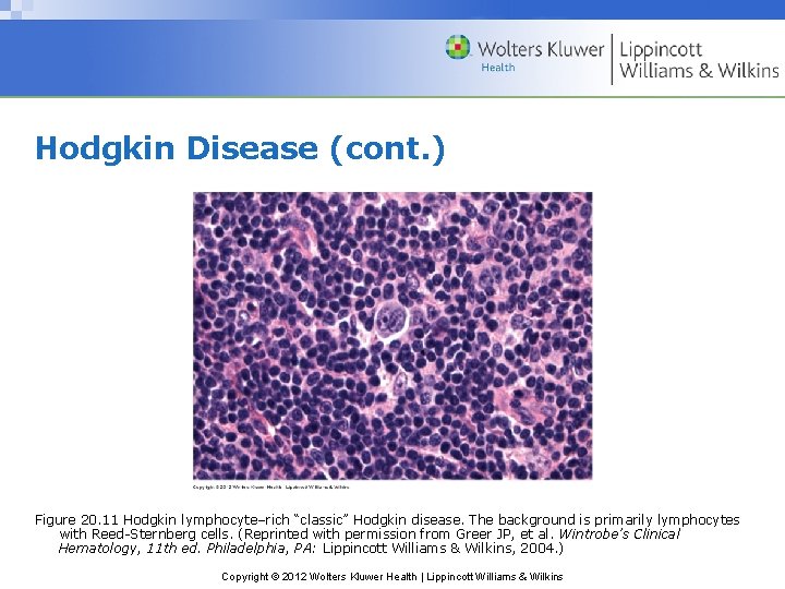 Hodgkin Disease (cont. ) Figure 20. 11 Hodgkin lymphocyte–rich “classic” Hodgkin disease. The background