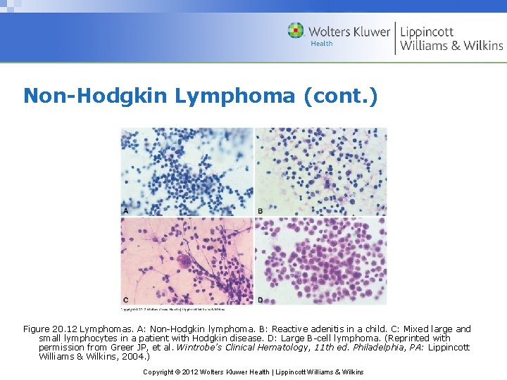 Non-Hodgkin Lymphoma (cont. ) Figure 20. 12 Lymphomas. A: Non-Hodgkin lymphoma. B: Reactive adenitis