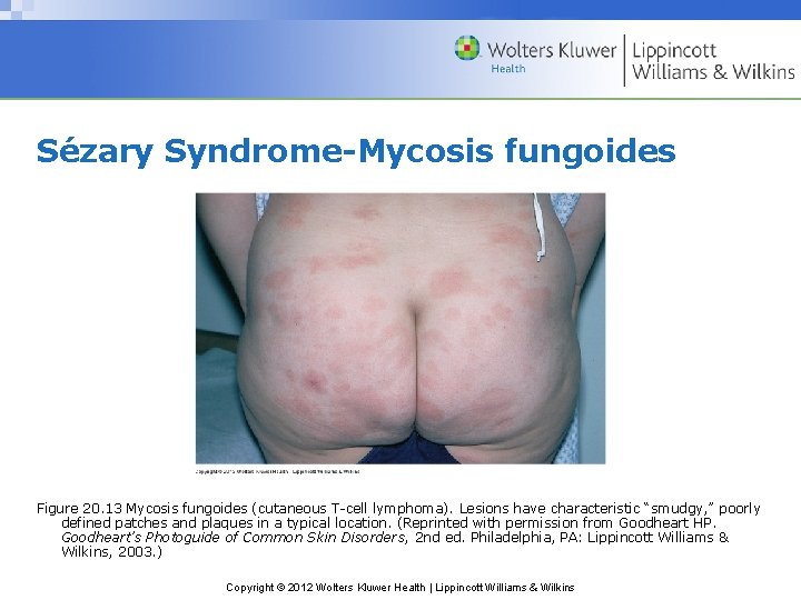 Sézary Syndrome-Mycosis fungoides Figure 20. 13 Mycosis fungoides (cutaneous T-cell lymphoma). Lesions have characteristic