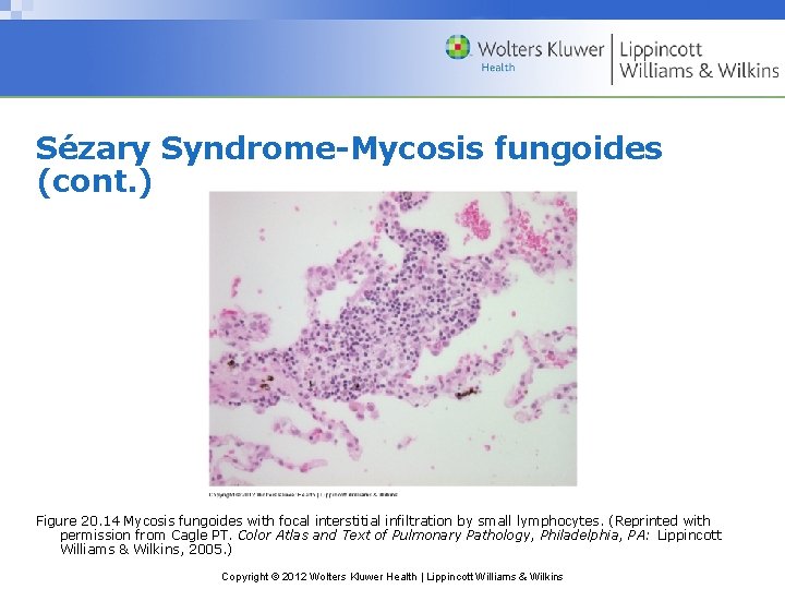 Sézary Syndrome-Mycosis fungoides (cont. ) Figure 20. 14 Mycosis fungoides with focal interstitial infiltration