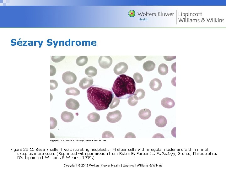 Sézary Syndrome Figure 20. 15 Sézary cells. Two circulating neoplastic T-helper cells with irregular