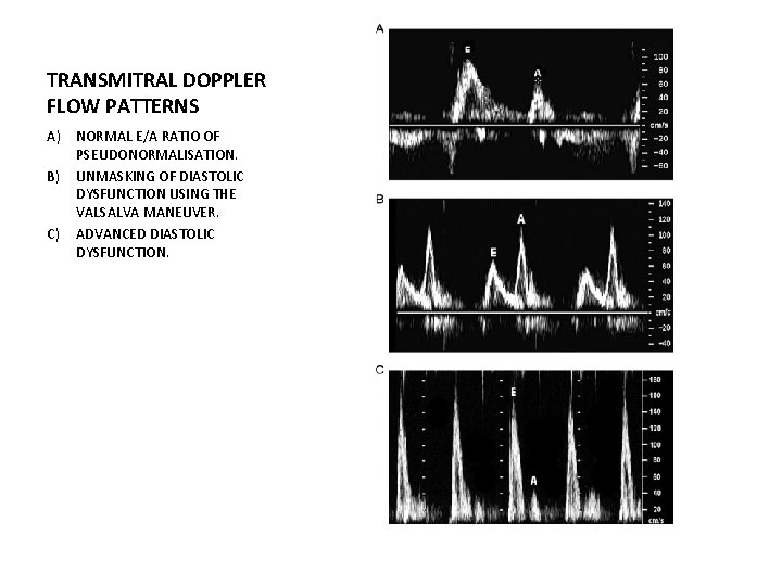 TRANSMITRAL DOPPLER FLOW PATTERNS A) NORMAL E/A RATIO OF PSEUDONORMALISATION. B) UNMASKING OF DIASTOLIC