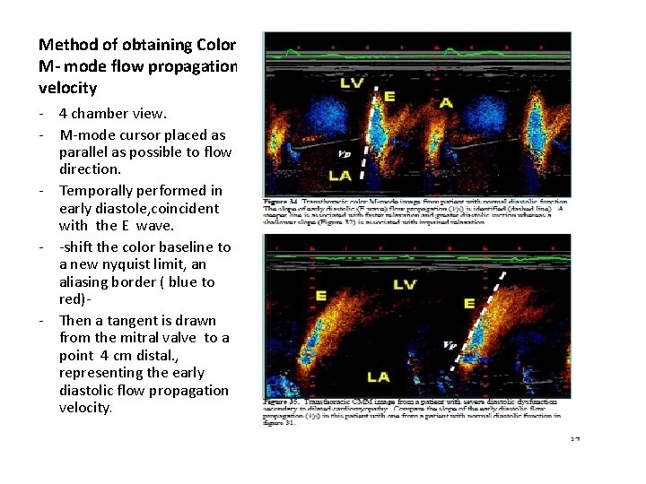 Method of obtaining Color M- mode flow propagation velocity - 4 chamber view. -
