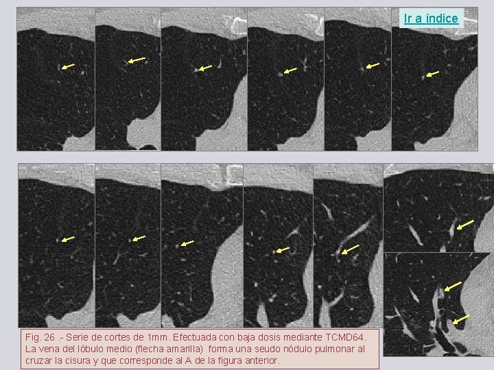 Ir a índice Fig. 26. - Serie de cortes de 1 mm. Efectuada con