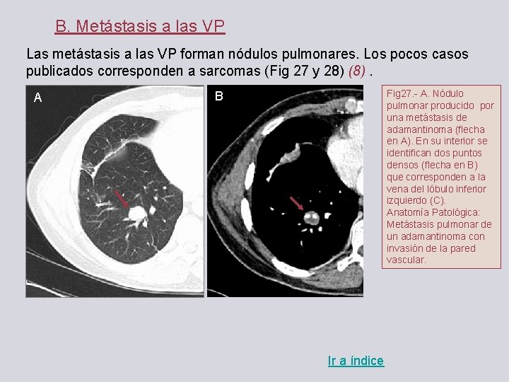 B. Metástasis a las VP Las metástasis a las VP forman nódulos pulmonares. Los