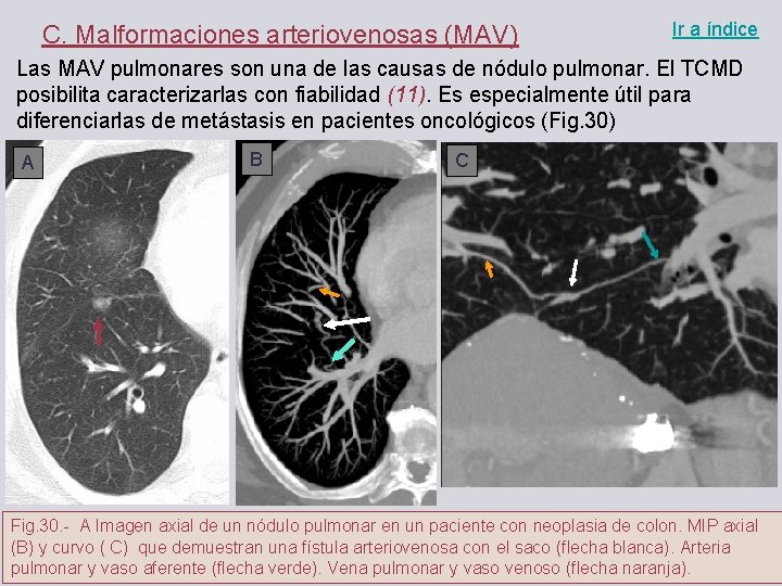 C. Malformaciones arteriovenosas (MAV) Ir a índice Las MAV pulmonares son una de las
