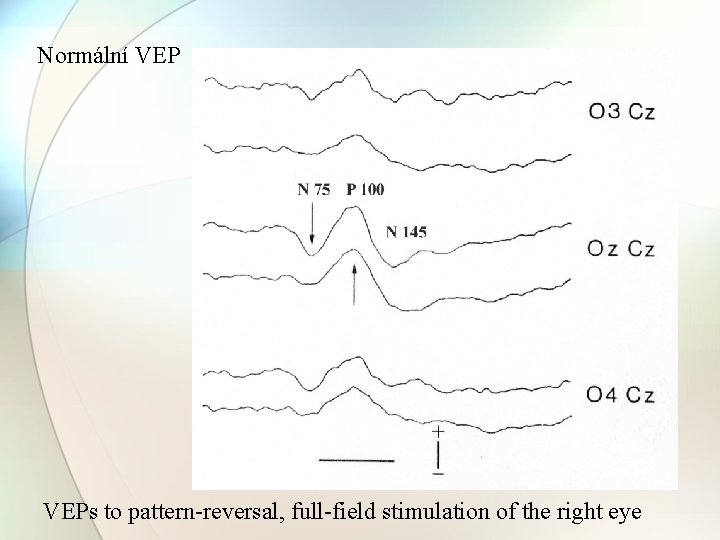 Normální VEPs to pattern-reversal, full-field stimulation of the right eye 