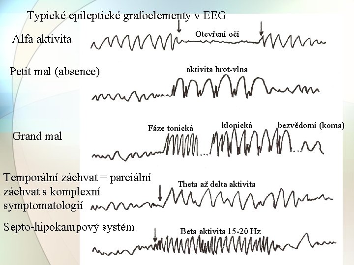 Typické epileptické grafoelementy v EEG Otevření očí Alfa aktivita hrot-vlna Petit mal (absence) Grand