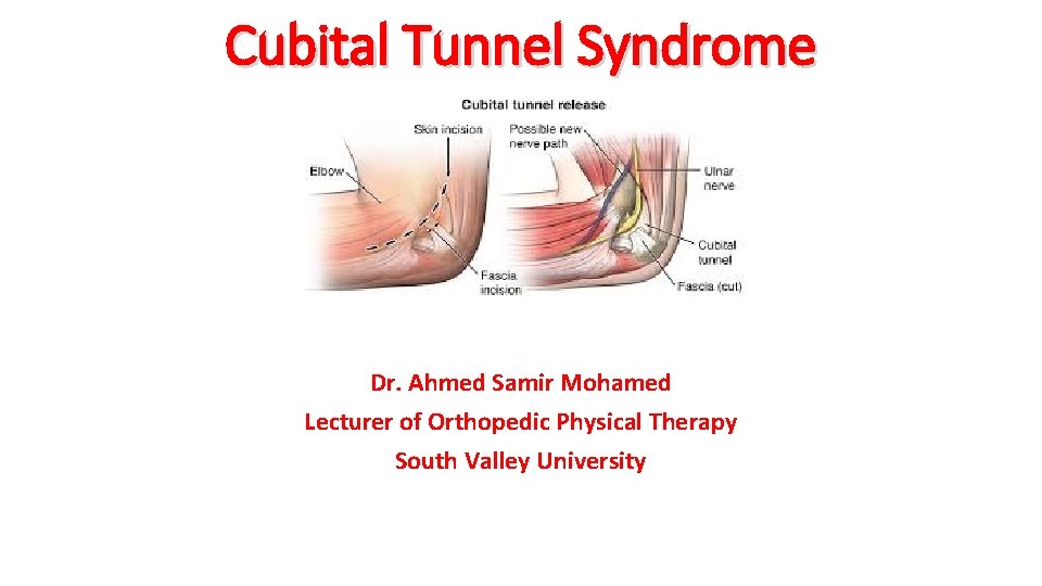 Cubital Tunnel Syndrome Dr. Ahmed Samir Mohamed Lecturer of Orthopedic Physical Therapy South Valley