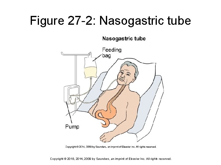 Figure 27 -2: Nasogastric tube Copyright © 2018, 2014, 2009 by Saunders, an imprint