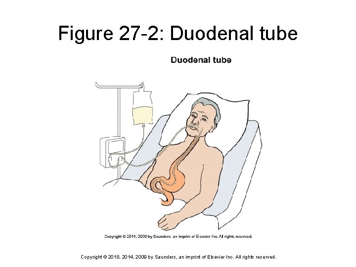 Figure 27 -2: Duodenal tube Copyright © 2018, 2014, 2009 by Saunders, an imprint