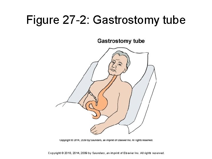 Figure 27 -2: Gastrostomy tube Copyright © 2018, 2014, 2009 by Saunders, an imprint