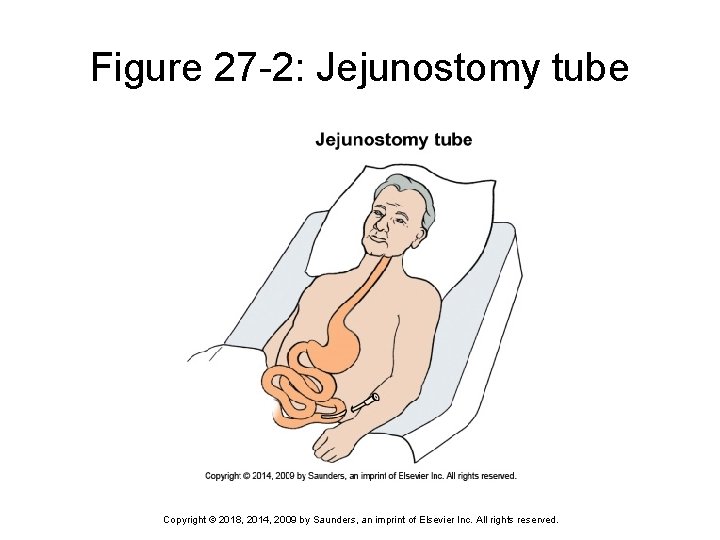 Figure 27 -2: Jejunostomy tube Copyright © 2018, 2014, 2009 by Saunders, an imprint