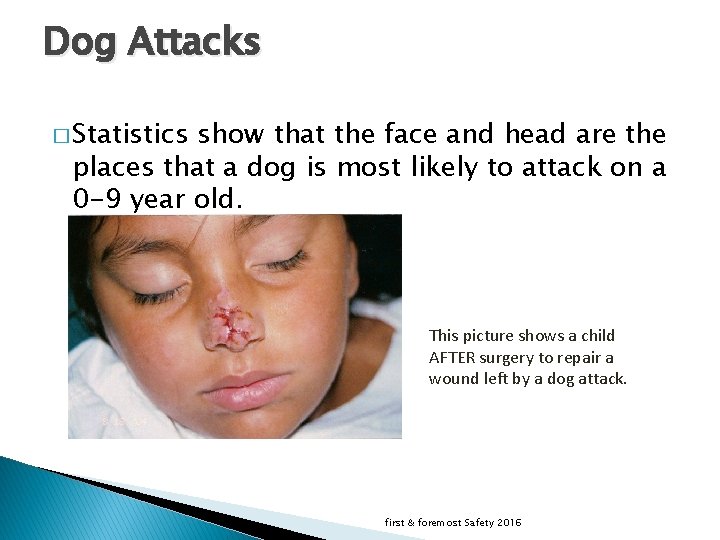 Dog Attacks � Statistics show that the face and head are the places that