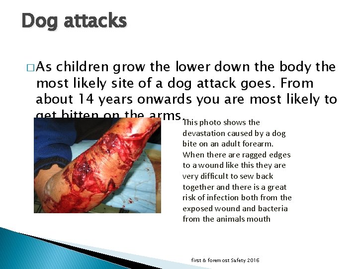 Dog attacks � As children grow the lower down the body the most likely