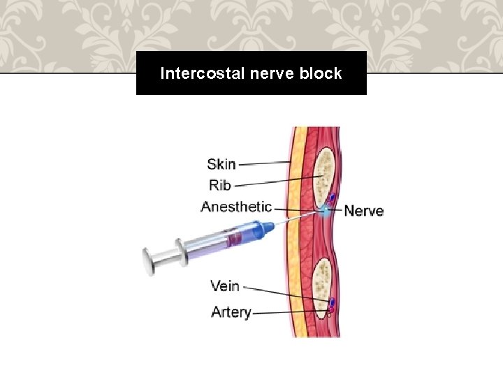 Intercostal nerve block 