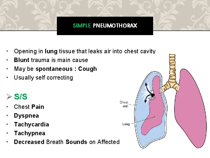 SIMPLE PNEUMOTHORAX • • Opening in lung tissue that leaks air into chest cavity