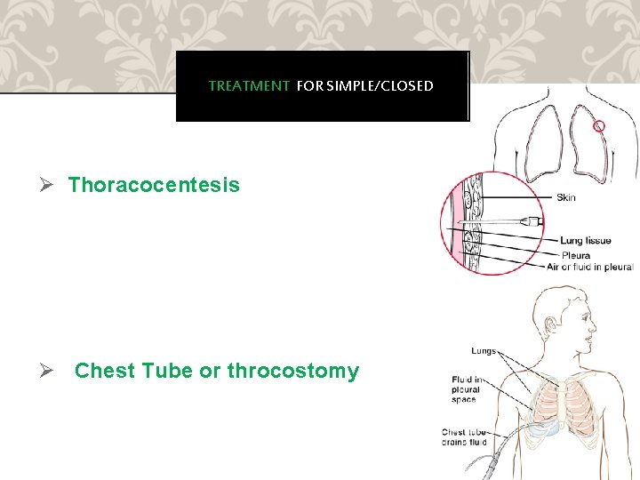 TREATMENT FOR SIMPLE/CLOSED Ø Thoracocentesis Ø Chest Tube or throcostomy 