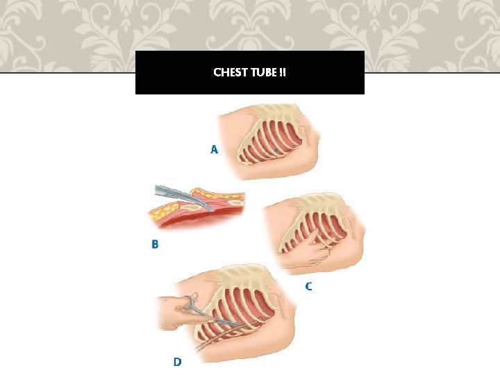 CHEST TUBE !! 