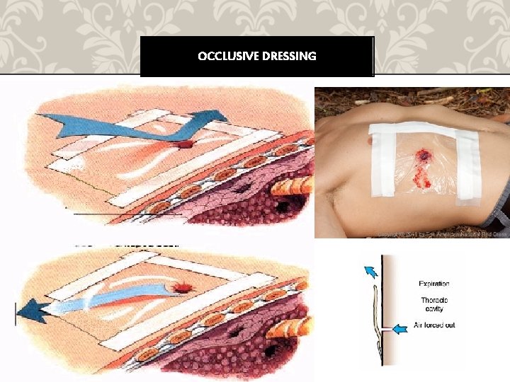 OCCLUSIVE DRESSING 