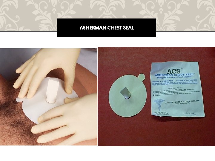 ASHERMAN CHEST SEAL 