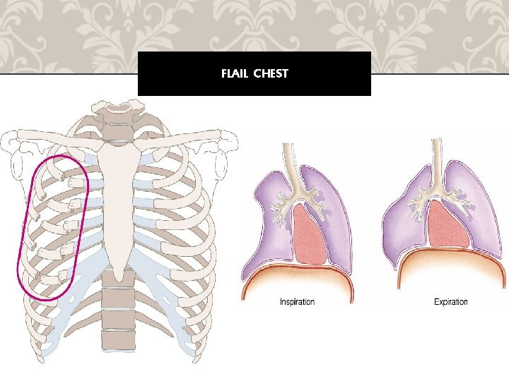 FLAIL CHEST 