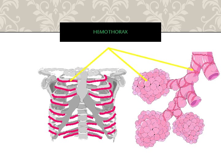 HEMOTHORAX 