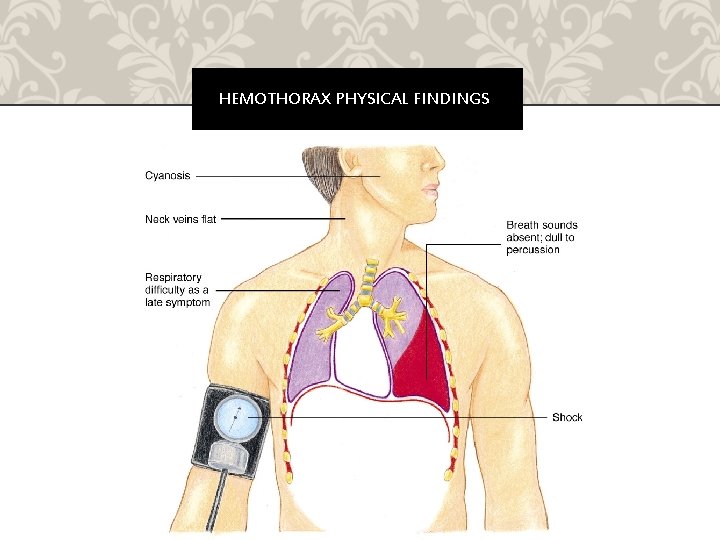 HEMOTHORAX PHYSICAL FINDINGS 