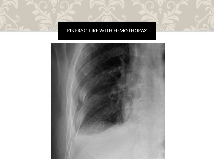 RIB FRACTURE WITH HEMOTHORAX 